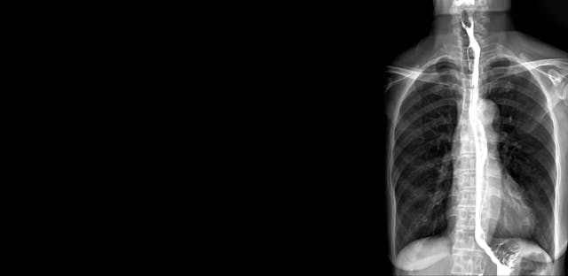 Esophagram or Barium swallow AP view is an X-ray of the esophagus ,The patient drinks a liquid that contains barium .The liquid coats the esophagus and X-rays are taken for finding cancer | Image credit: - © samunella - © stock.adobe.com