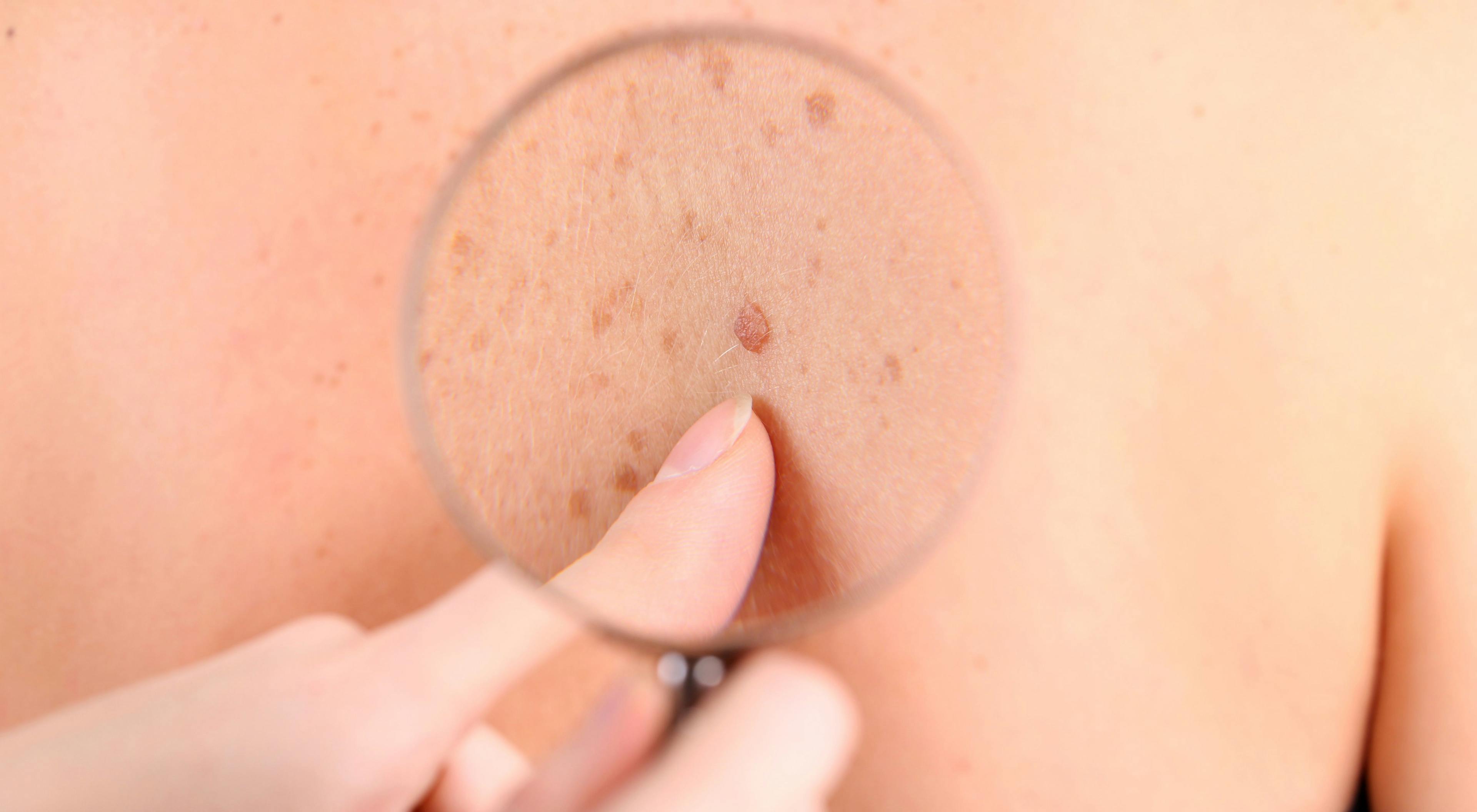 Image of a magnifying glass on skin cancer.