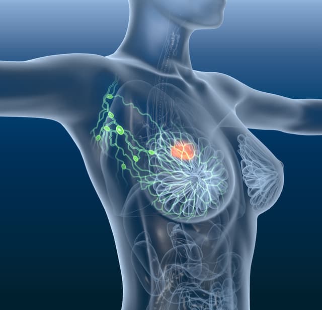 Illustration of a person with breast cancer. 