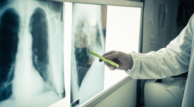 Picture of Doctor pointing at an X-RAY image of lung.