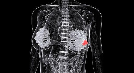 Illustration of a tumor in a patients' left breast. 