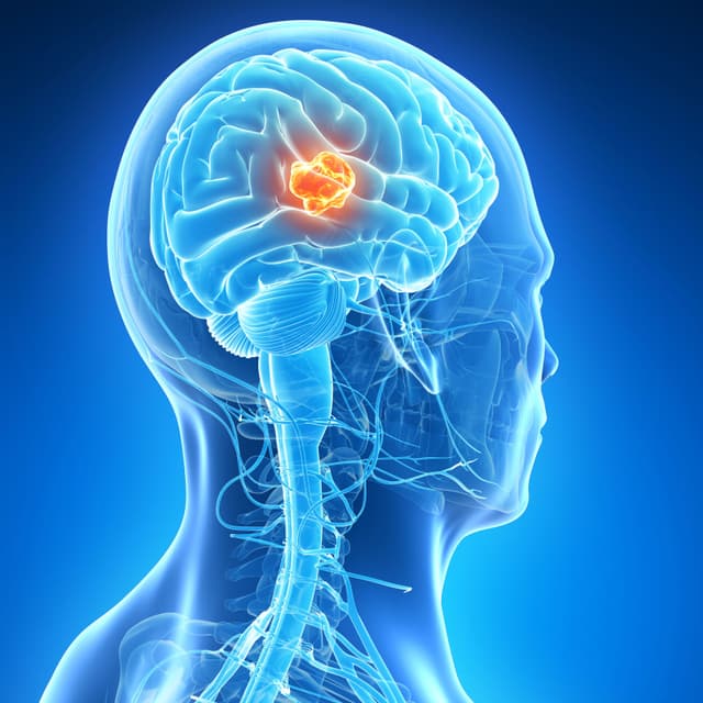 Illustration of a person with a brain tumor.