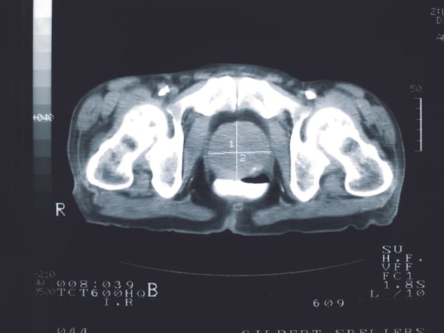 scan image of a prostate 