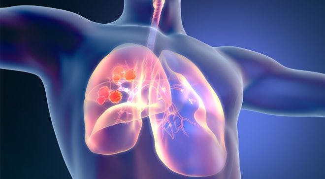 Blood Test Speedily Identifies Biomarkers to Help Guide NSCLC Treatment Decisions