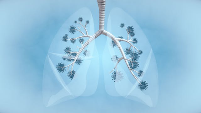 Illustration of tumors in both lungs. 