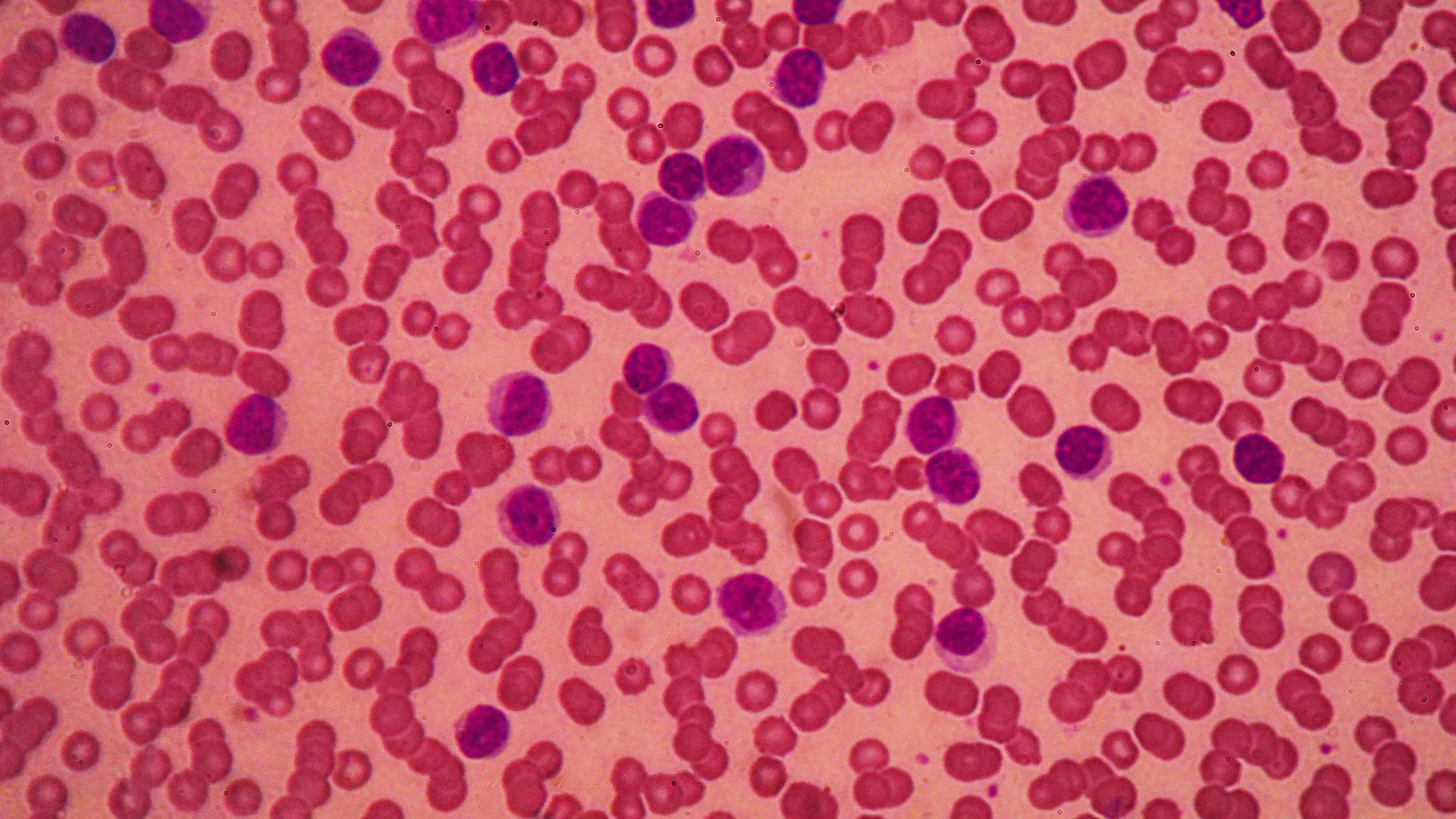 Image of small lymphocytic leukemia. 