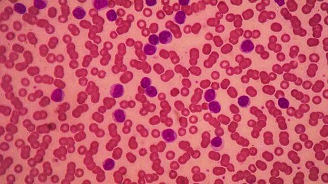 Image of small lymphocytic leukemia. 