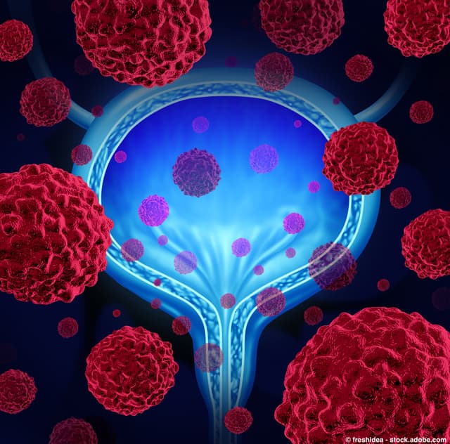 Tranexamic Acid During Radical Cystectomy Does Not Lead to Blood Transfusion Reduction in Bladder Cancer