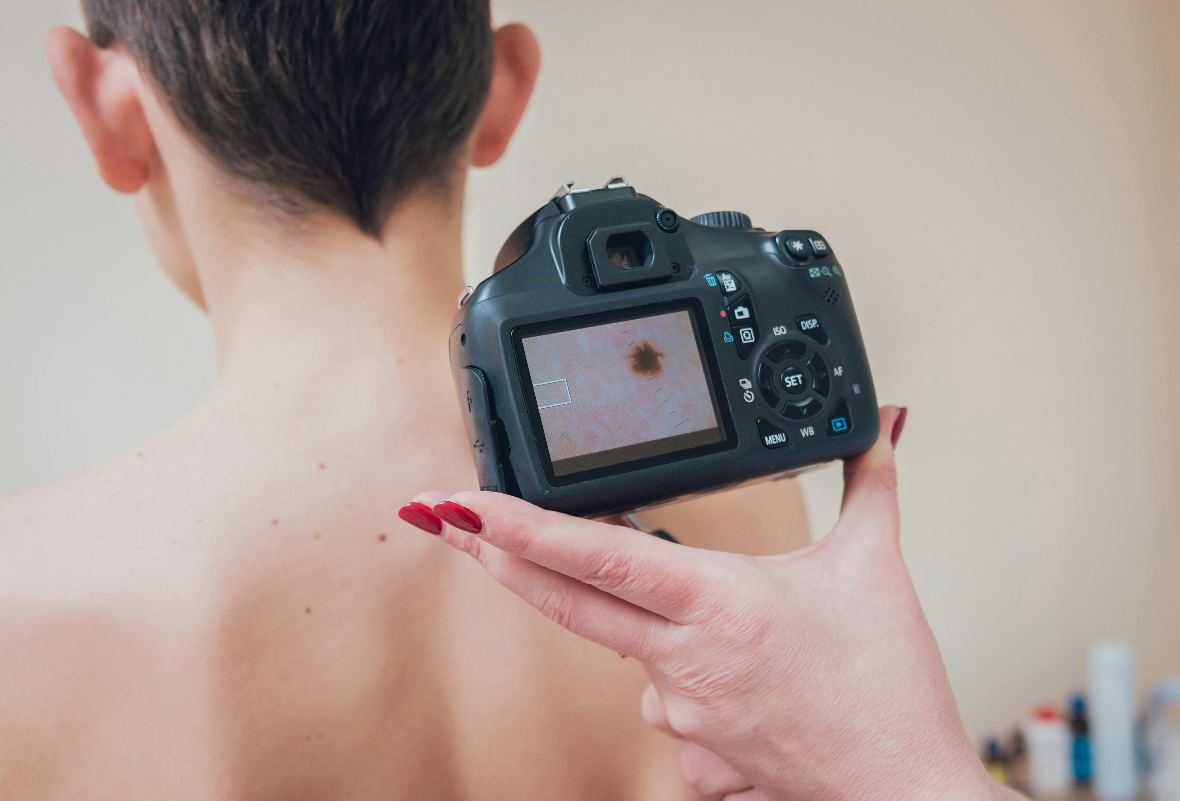 Image of a doctor examining skin cancer. 