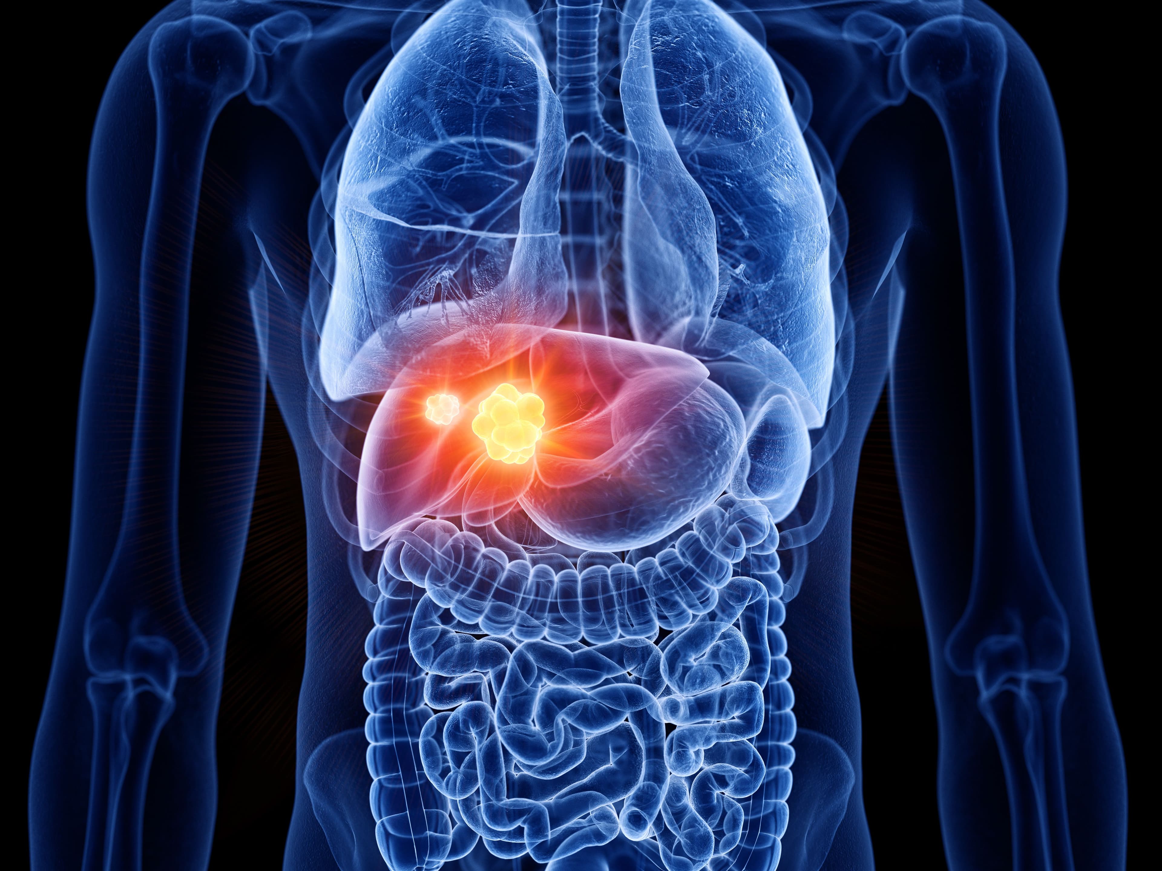 Liver Cancer