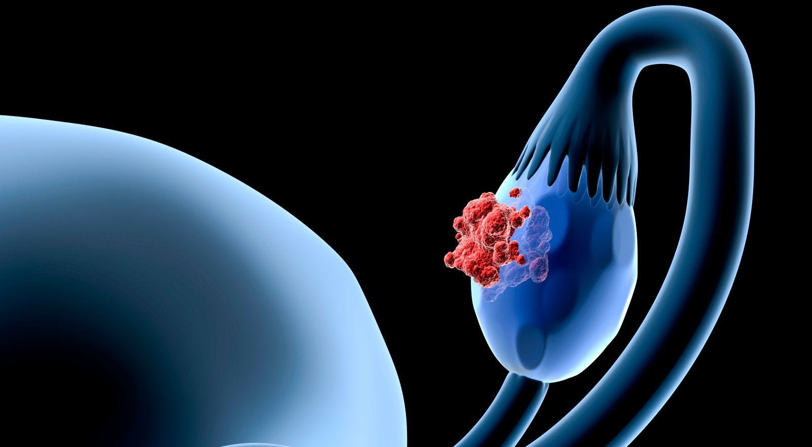 Chemotherapy "Bath" Warms Up Chances of Ovarian Cancer Survival 