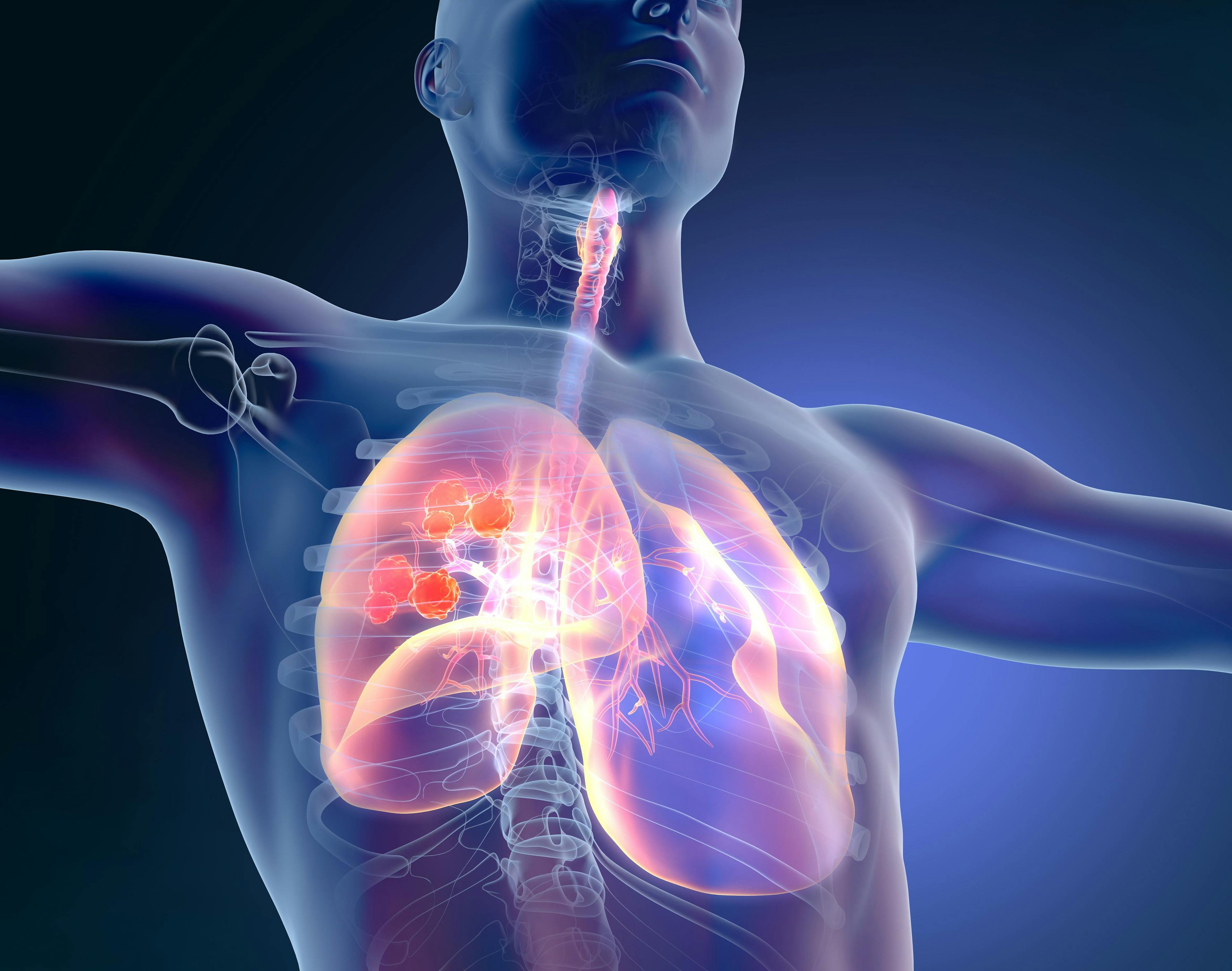 Decreased Rates of Lung Cancer Screening Highlight Need for Greater Awareness