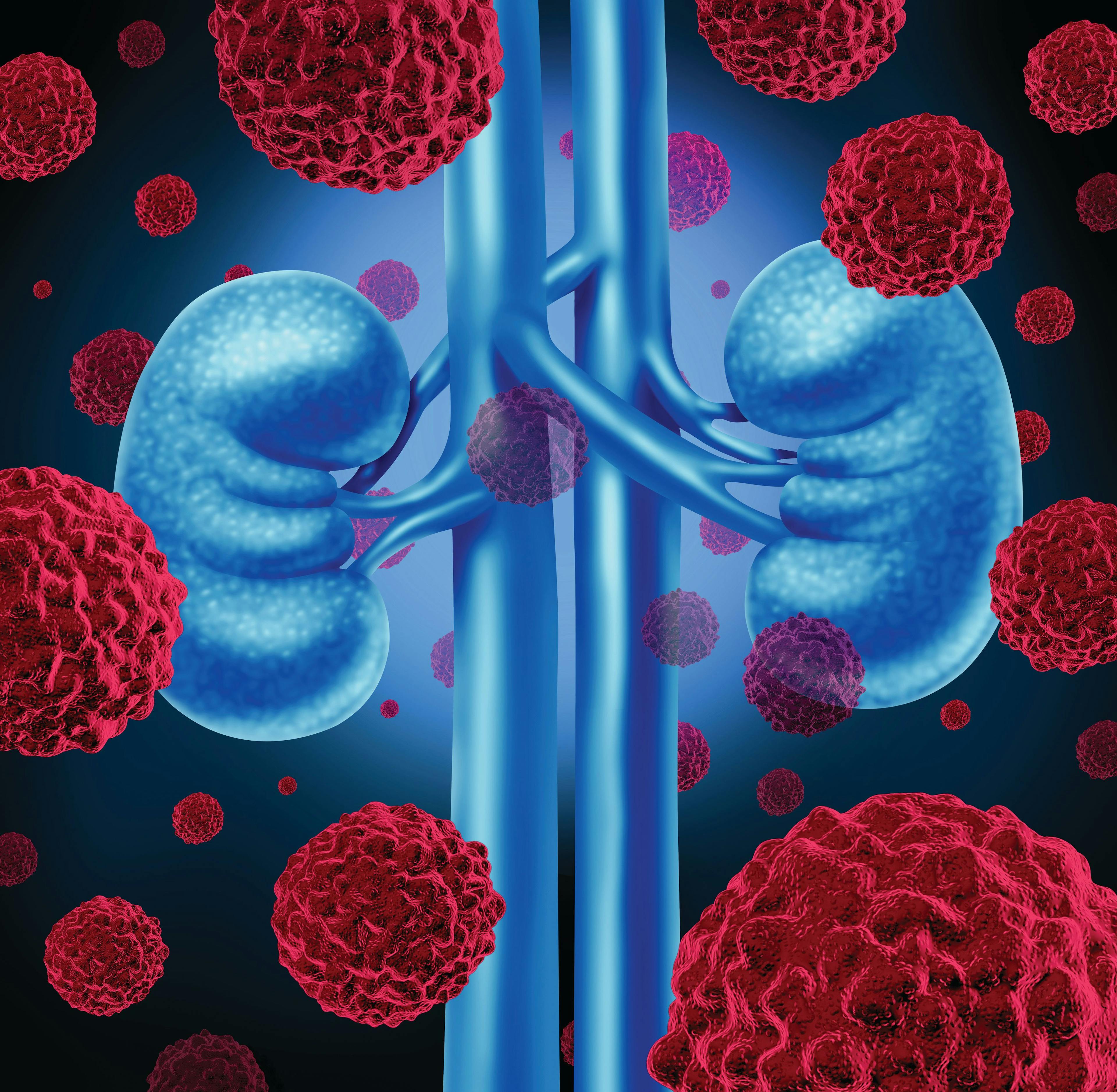 NCCN Recommends Lenvima Plus Keytruda for First-Line Renal Cell Carcinoma: What Patients Should Know